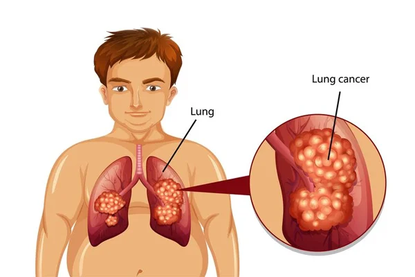 Lung Cancer