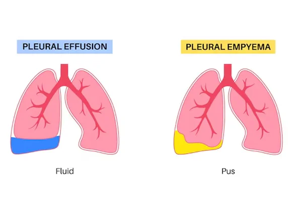 Pleural Empyema