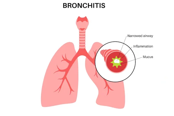Bronchiectasis