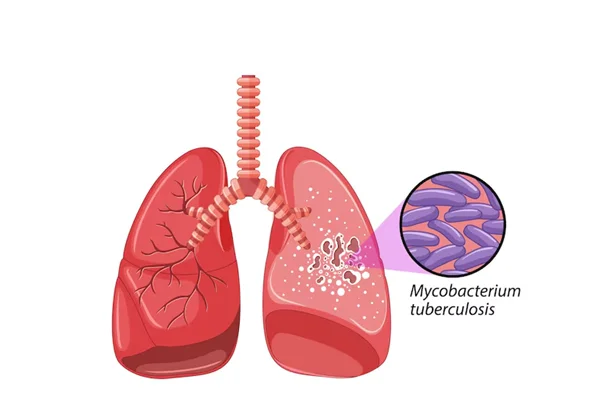 Tuberculosis and Complications