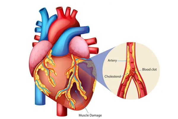 Chest Trauma