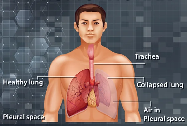 Mediastinal Tumours
