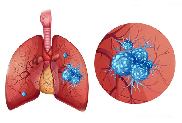 Lung Nodules