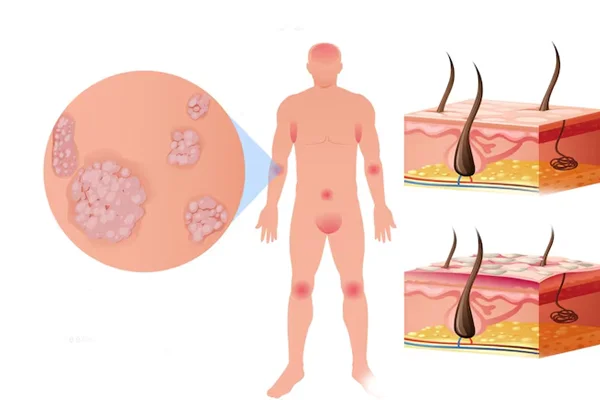Bullous Diseases